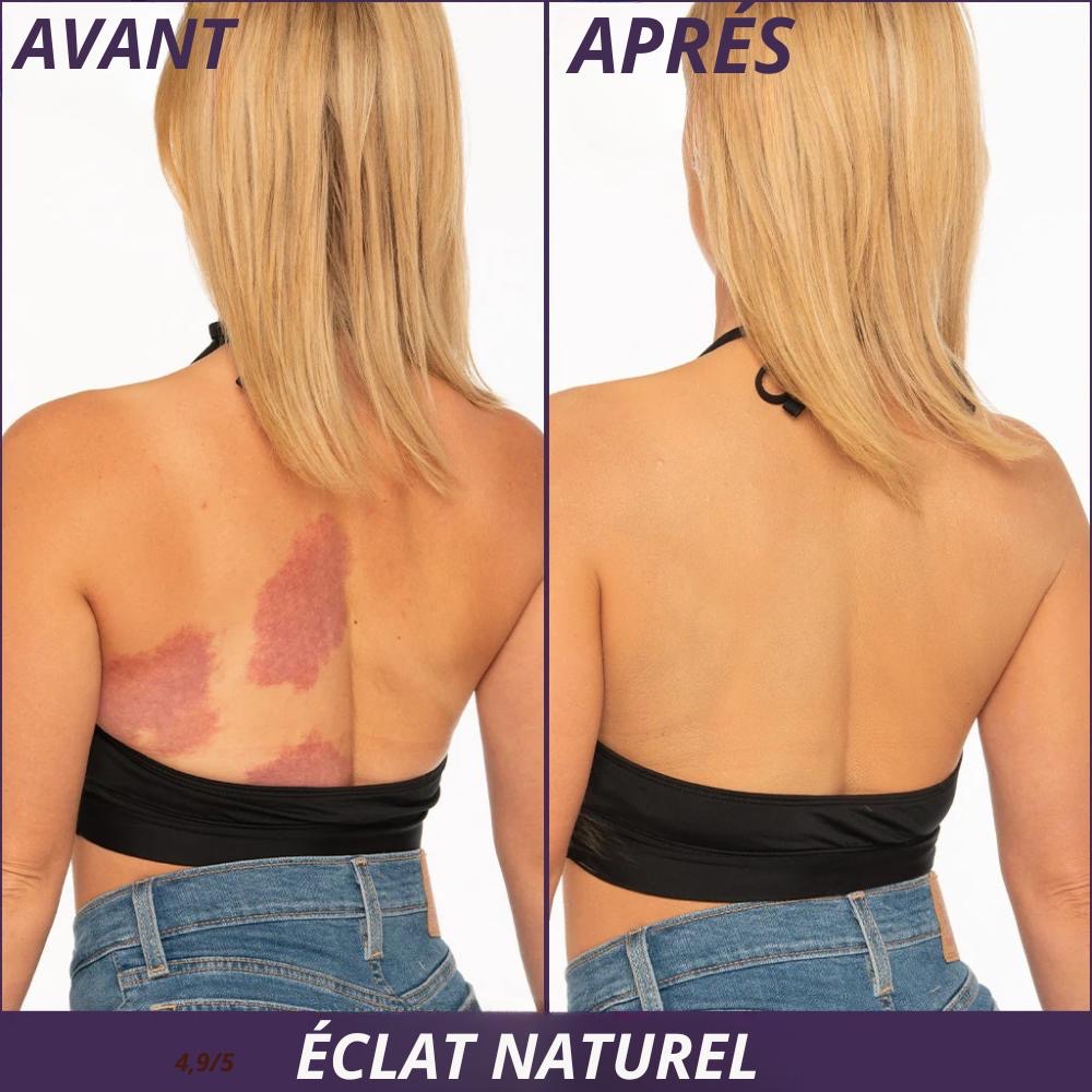 Lunisse™️ Votre crème qui couvre vos problèmes de peau